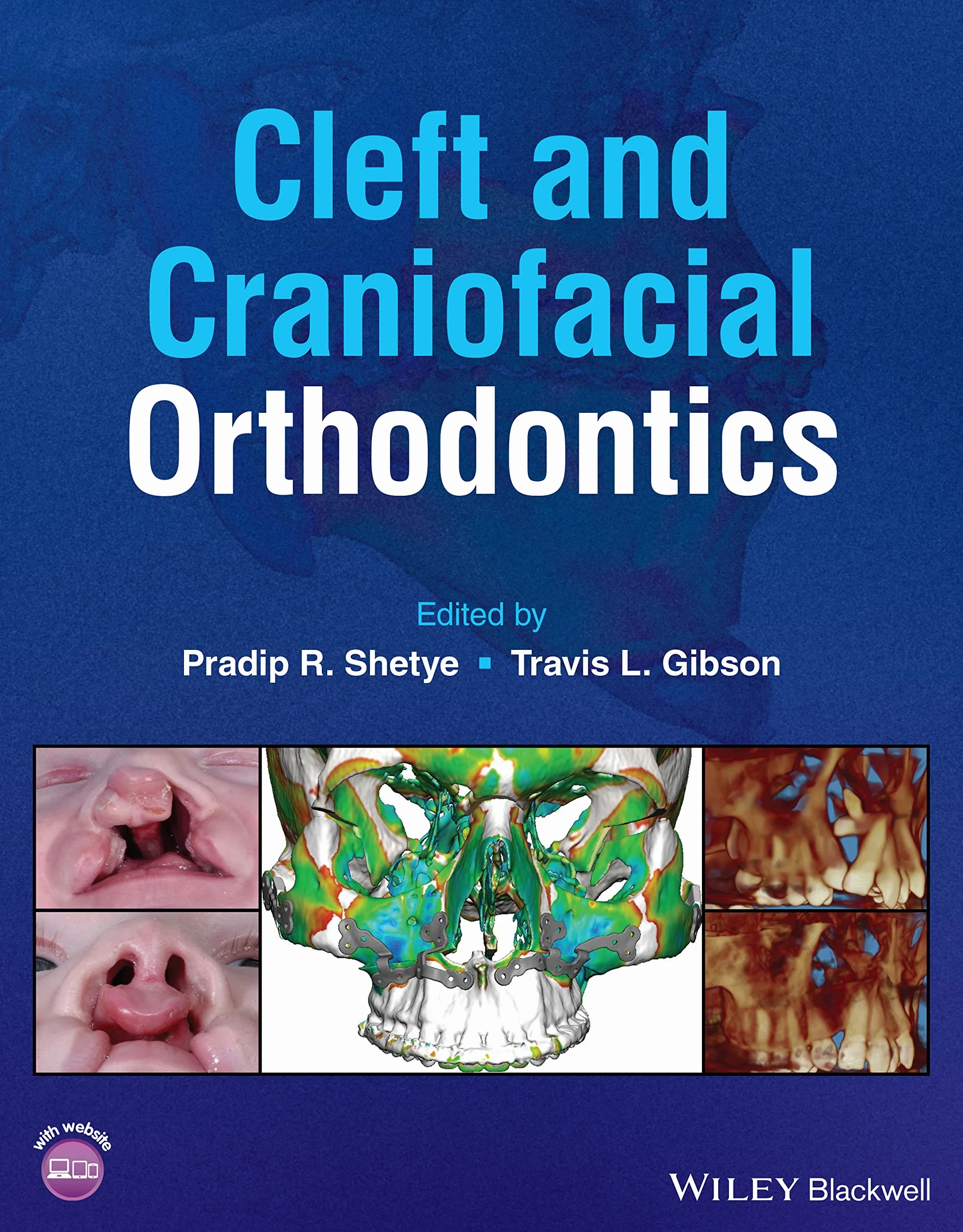 Cleft and Craniofacial Orthodontics
