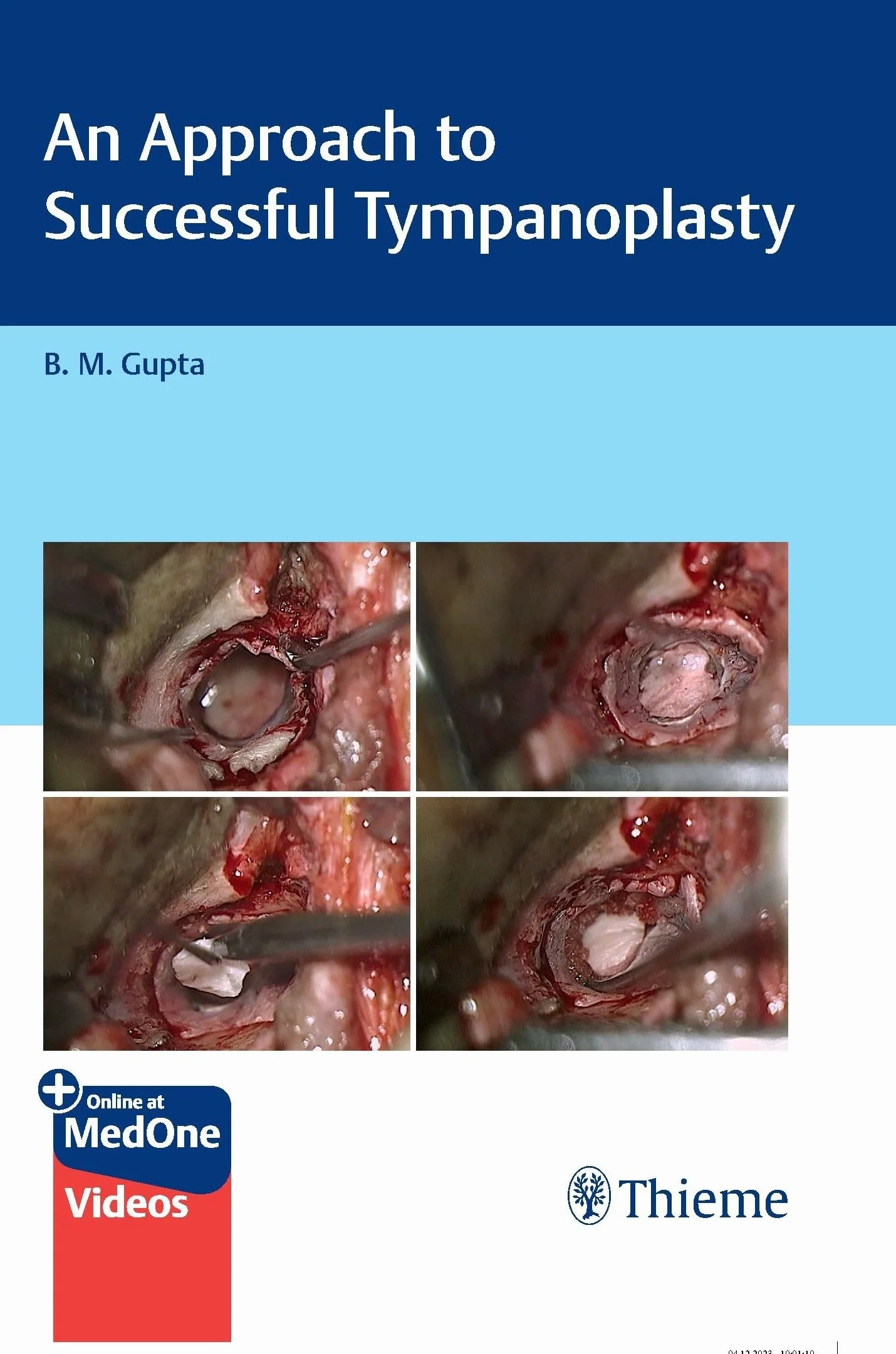 An Approach to Successful Tympanoplasty