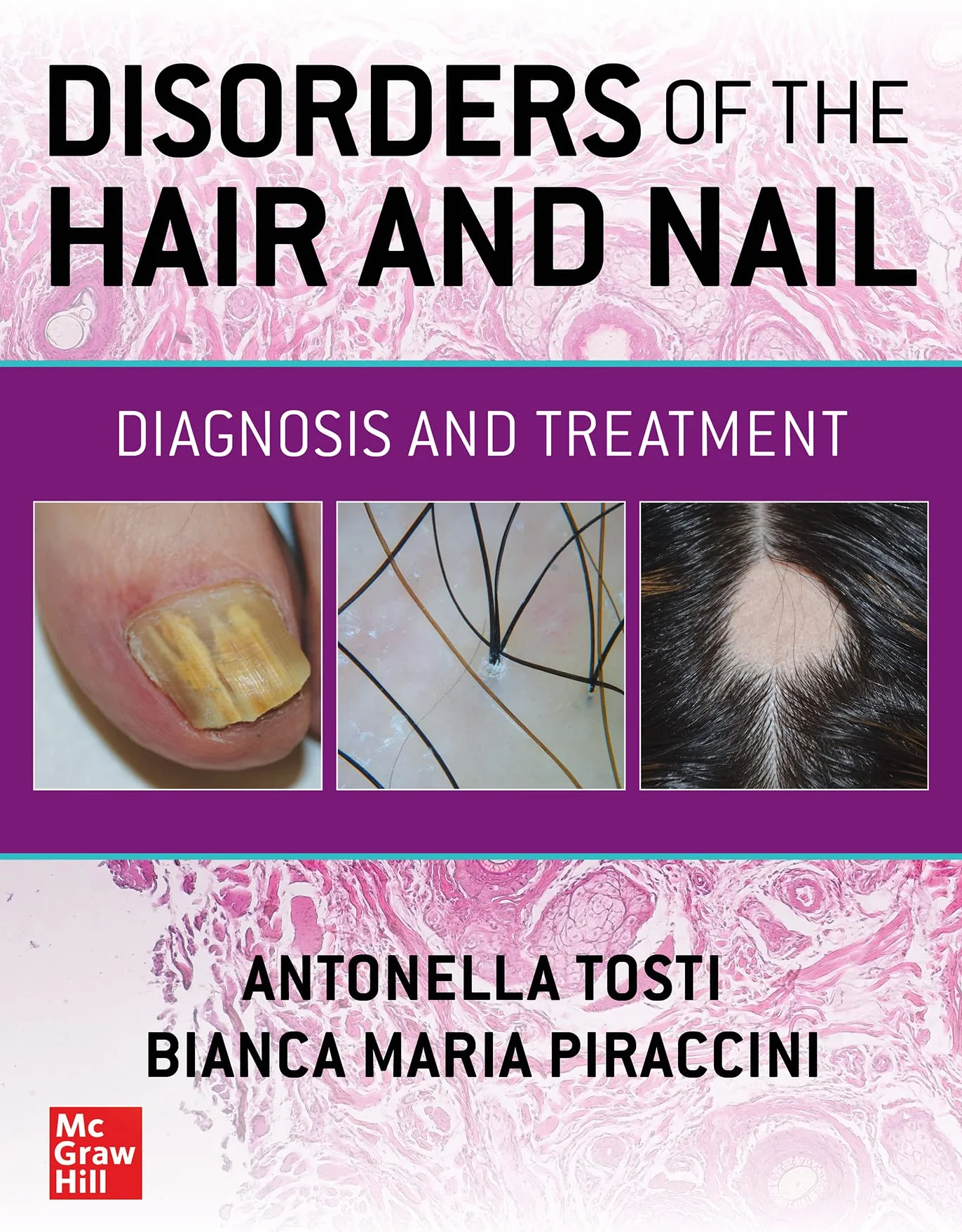 Disorders of the Hair and Nail: Diagnosis and Treatment